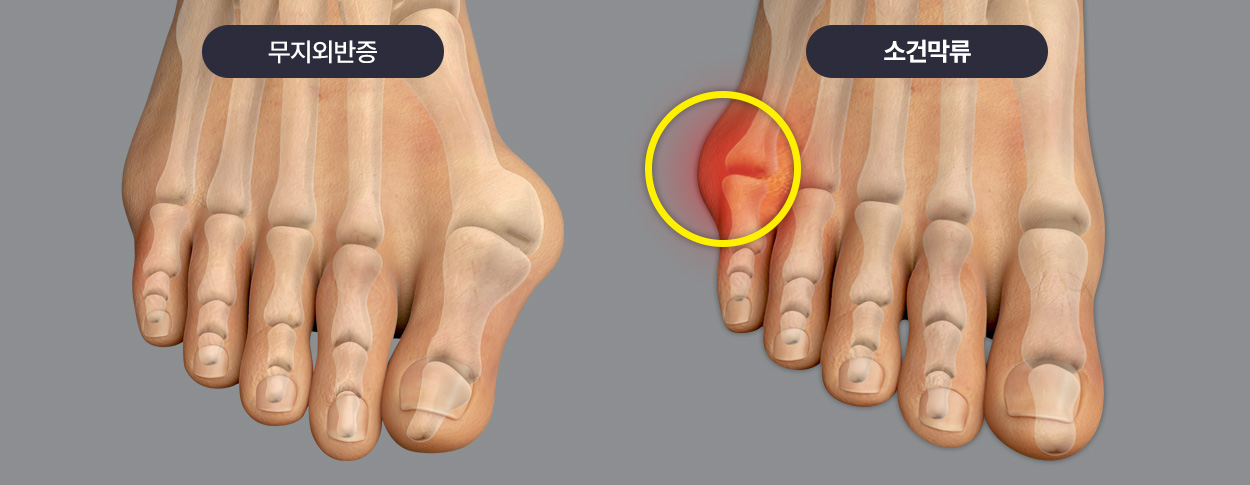 무지외반증 / 소건막류