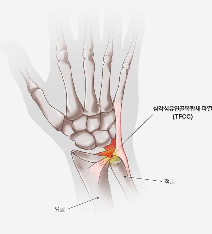 요골 / 삼각섬유연골복합체 파열(TFCC) / 척골