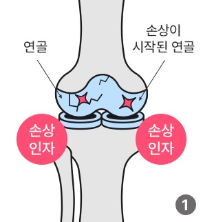 연골(손상인자) / 손상이 시작된 연골(손상인자)