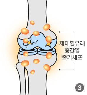 제대혈유래 중간엽 줄기세포