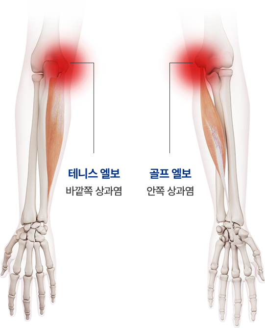 테니스 엘보 - 바깥쪽 상과염, 골프 엘보 - 안쪽 상과염